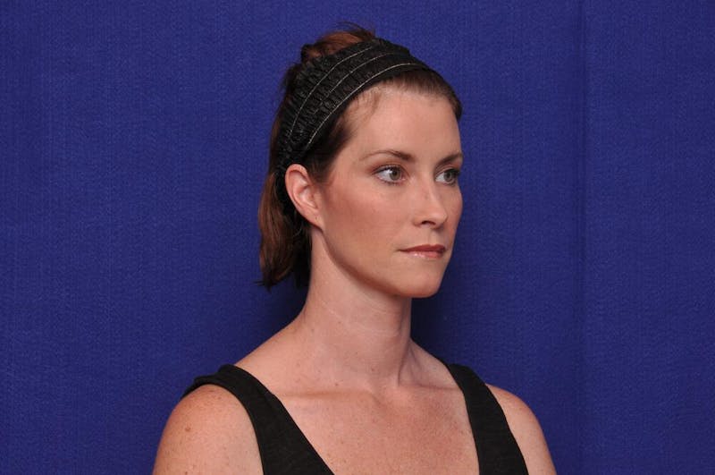 Liquid Facelift Before & After Gallery - Patient 290529 - Image 8