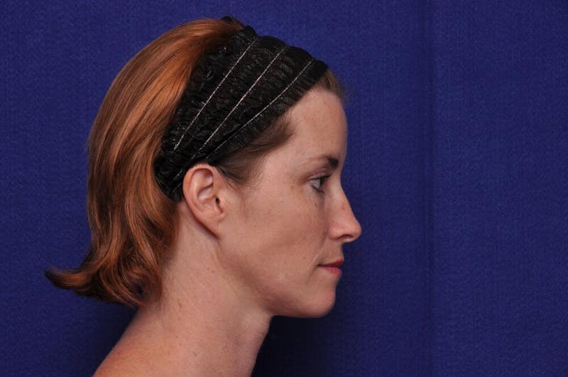 Liquid Facelift Before & After Gallery - Patient 290529 - Image 9