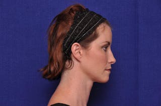 Liquid Facelift Before & After Gallery - Patient 290529 - Image 10