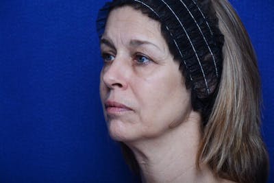 Liquid Facelift Before & After Gallery - Patient 309791 - Image 1
