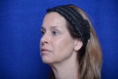 Liquid Facelift Before & After Gallery - Patient 309791 - Image 2