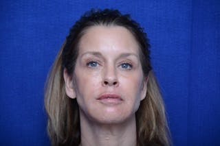 Liquid Facelift Before & After Gallery - Patient 309791 - Image 4