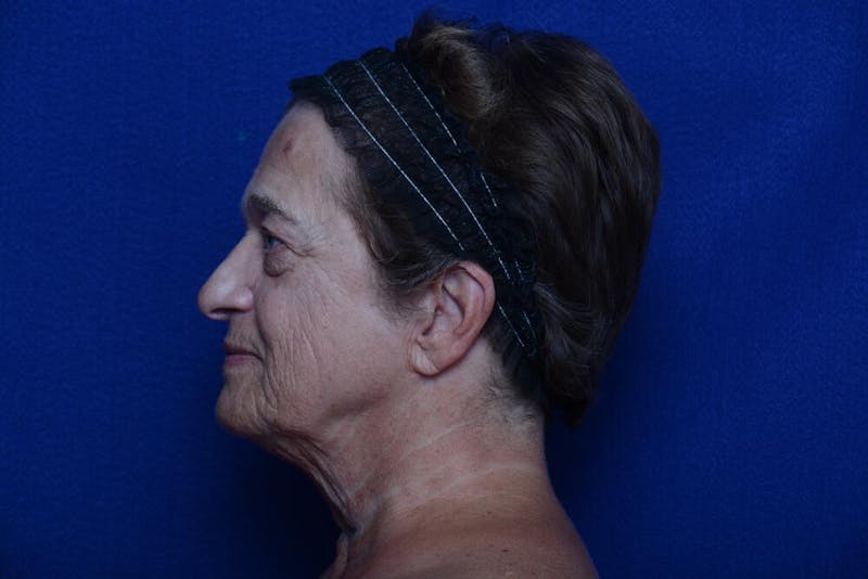 Lower Blepharoplasty Before & After Gallery - Patient 299934 - Image 3
