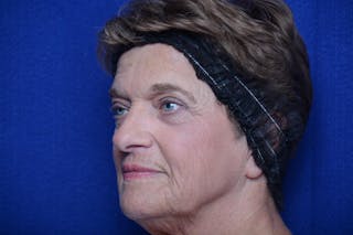 Lower Blepharoplasty Before & After Gallery - Patient 299934 - Image 6