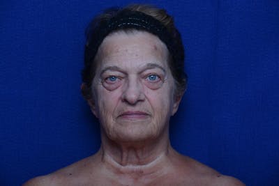 Lower Blepharoplasty Before & After Gallery - Patient 299934 - Image 1