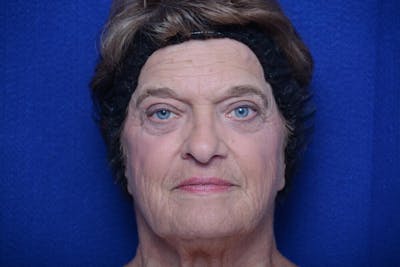 Lower Blepharoplasty Before & After Gallery - Patient 299934 - Image 2