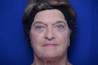 Lower Blepharoplasty Before & After Gallery - Patient 299934 - Image 2
