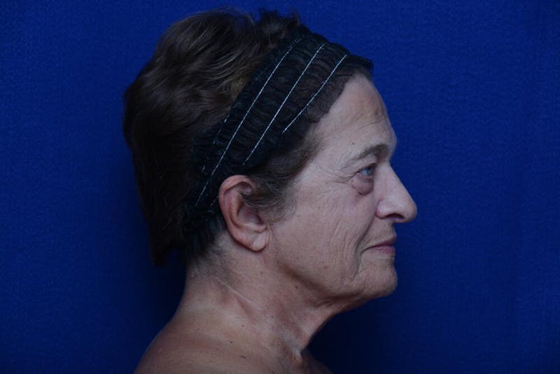 Lower Blepharoplasty Before & After Gallery - Patient 299934 - Image 9