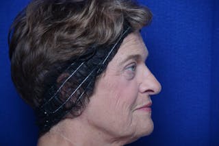 Lower Blepharoplasty Before & After Gallery - Patient 299934 - Image 10