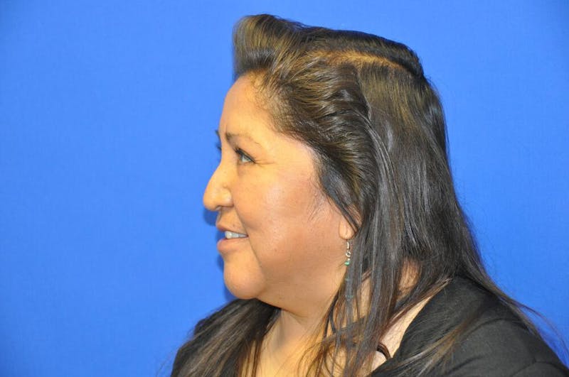 Lower Blepharoplasty Before & After Gallery - Patient 612458 - Image 4