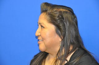 Lower Blepharoplasty Before & After Gallery - Patient 612458 - Image 4