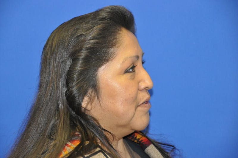 Lower Blepharoplasty Before & After Gallery - Patient 612458 - Image 9
