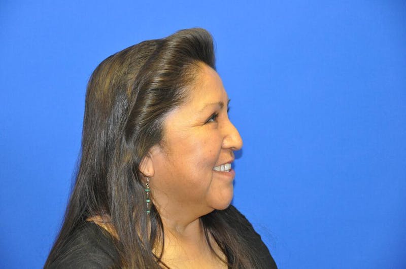 Lower Blepharoplasty Before & After Gallery - Patient 612458 - Image 10