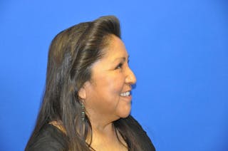 Lower Blepharoplasty Before & After Gallery - Patient 612458 - Image 10