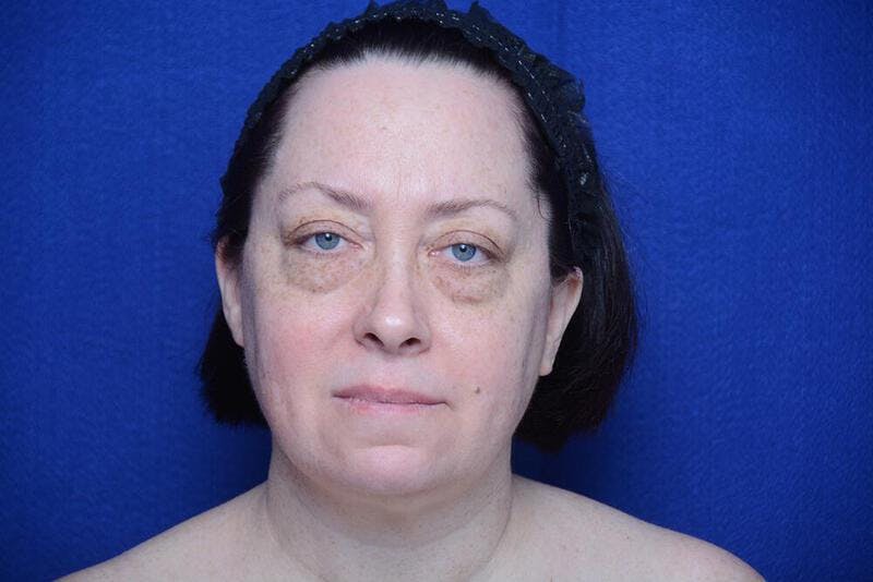 Lower Blepharoplasty Before & After Gallery - Patient 842697 - Image 1