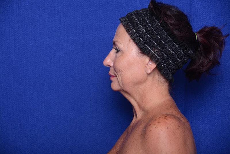 Lower Blepharoplasty Before & After Gallery - Patient 176870 - Image 3