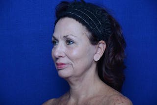 Lower Blepharoplasty Before & After Gallery - Patient 176870 - Image 6