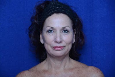 Lower Blepharoplasty Before & After Gallery - Patient 176870 - Image 2