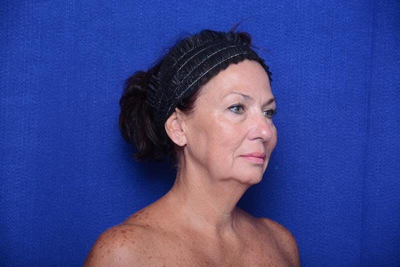 Lower Blepharoplasty Before & After Gallery - Patient 176870 - Image 7