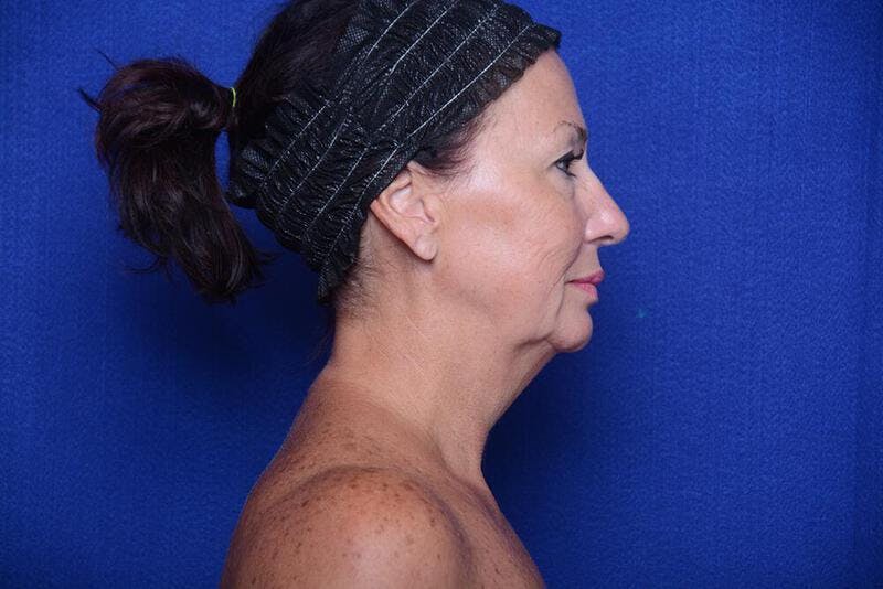 Lower Blepharoplasty Before & After Gallery - Patient 176870 - Image 9