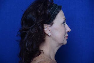 Lower Blepharoplasty Before & After Gallery - Patient 176870 - Image 10
