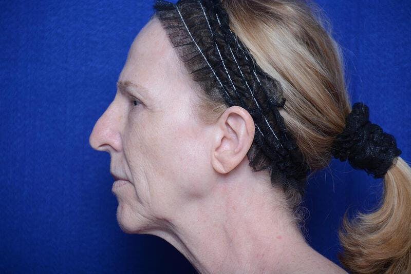 Lower Blepharoplasty Before & After Gallery - Patient 130179 - Image 3