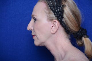 Lower Blepharoplasty Before & After Gallery - Patient 130179 - Image 4