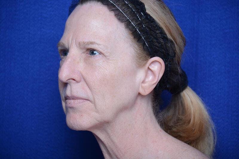 Lower Blepharoplasty Before & After Gallery - Patient 130179 - Image 5