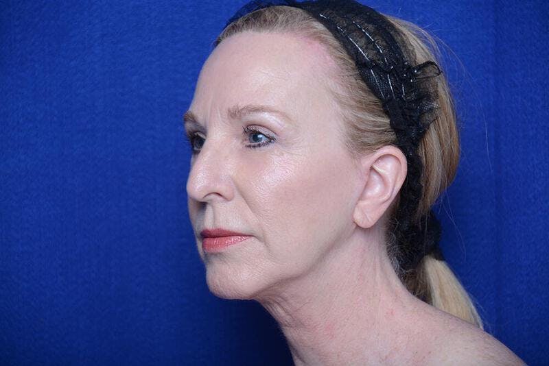 Lower Blepharoplasty Before & After Gallery - Patient 130179 - Image 6