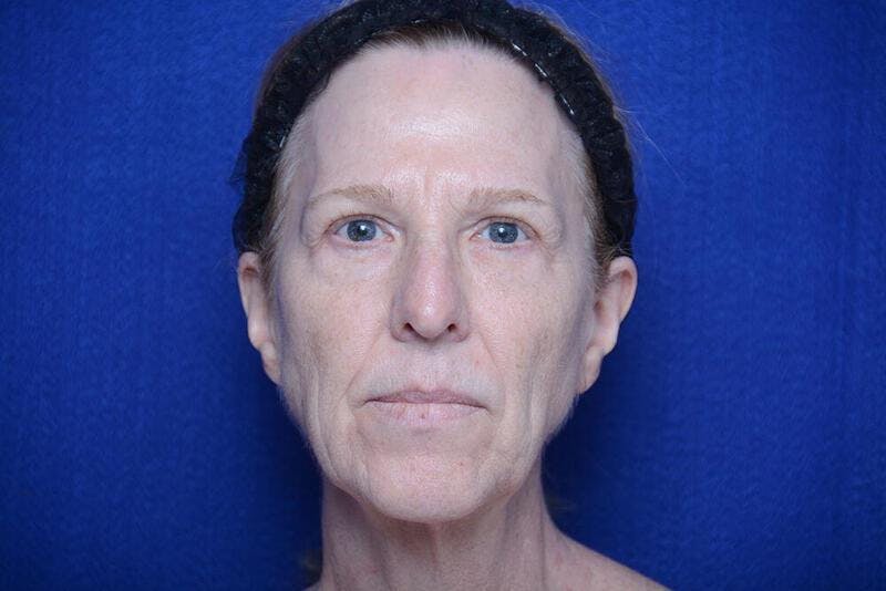 Lower Blepharoplasty Before & After Gallery - Patient 130179 - Image 1