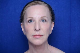 Lower Blepharoplasty Before & After Gallery - Patient 130179 - Image 2