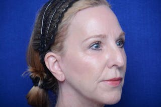 Lower Blepharoplasty Before & After Gallery - Patient 130179 - Image 8