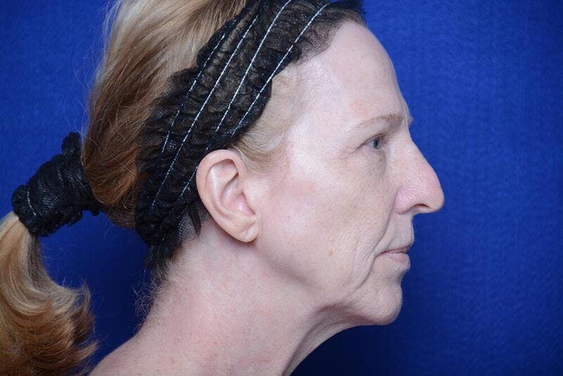 Lower Blepharoplasty Before & After Gallery - Patient 130179 - Image 9
