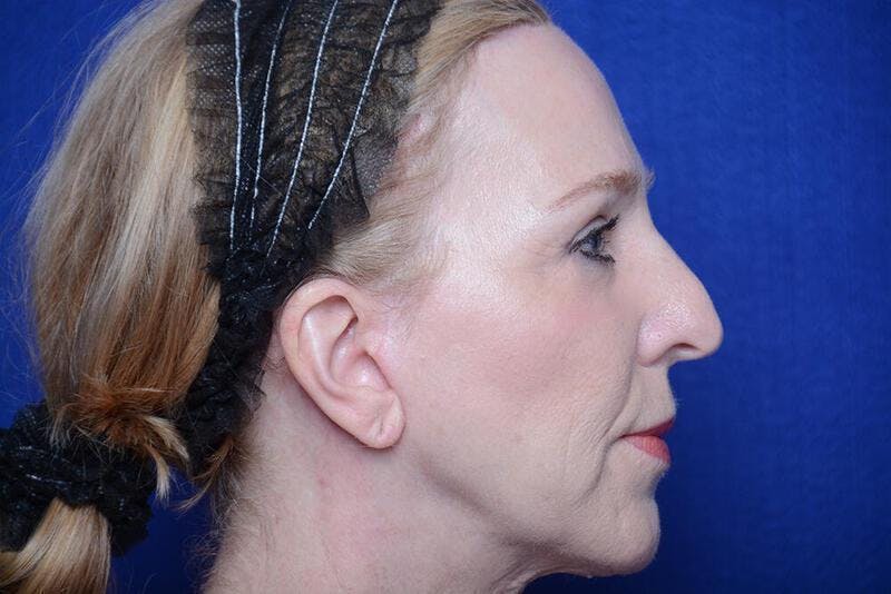 Lower Blepharoplasty Before & After Gallery - Patient 130179 - Image 10