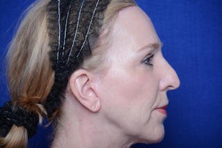 Lower Blepharoplasty Before & After Gallery - Patient 130179 - Image 10