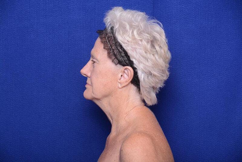 Lower Blepharoplasty Before & After Gallery - Patient 393861 - Image 3
