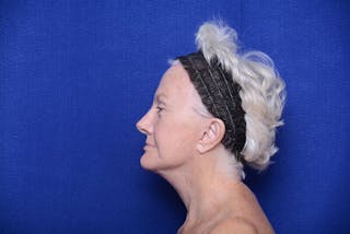 Lower Blepharoplasty Before & After Gallery - Patient 393861 - Image 4