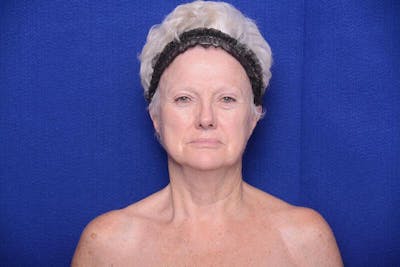 Lower Blepharoplasty Before & After Gallery - Patient 393861 - Image 1