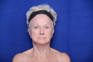 Lower Blepharoplasty Before & After Gallery - Patient 393861 - Image 2