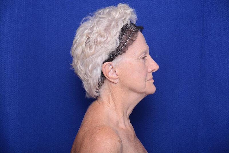Lower Blepharoplasty Before & After Gallery - Patient 393861 - Image 5