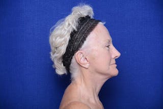Lower Blepharoplasty Before & After Gallery - Patient 393861 - Image 6