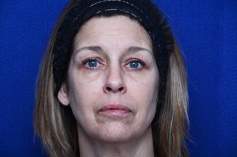 Lower Blepharoplasty Before & After Gallery - Patient 506440 - Image 1
