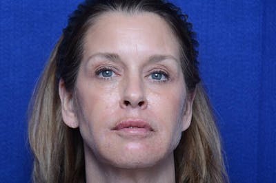 Lower Blepharoplasty Before & After Gallery - Patient 506440 - Image 2