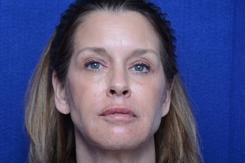 Lower Blepharoplasty Before & After Gallery - Patient 506440 - Image 2