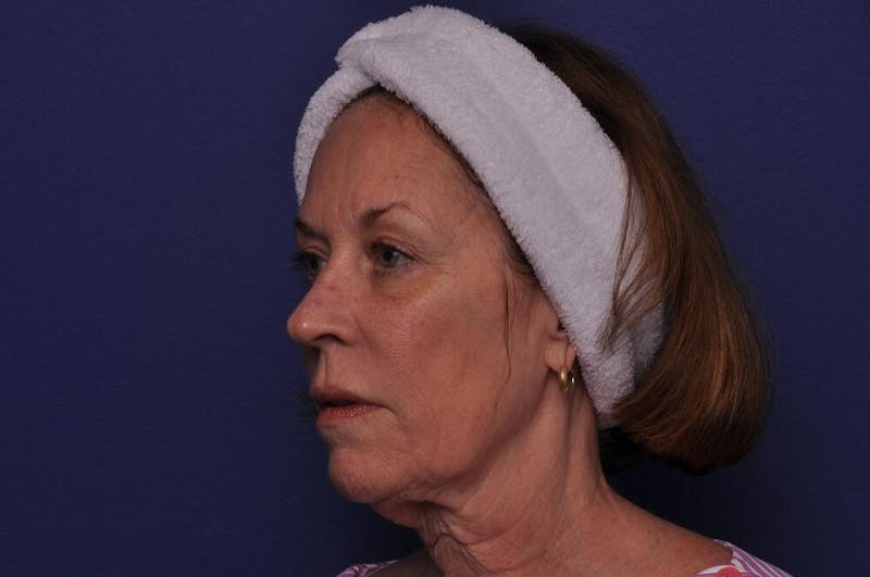 Renuva Before & After Gallery - Patient 112689 - Image 1