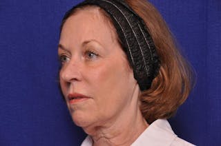 Renuva Before & After Gallery - Patient 112689 - Image 2