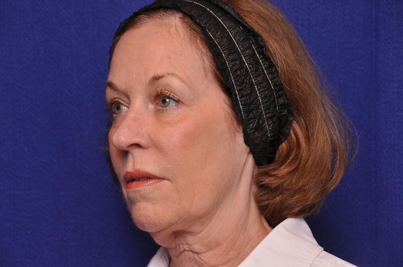 Renuva Before & After Gallery - Patient 112689 - Image 2