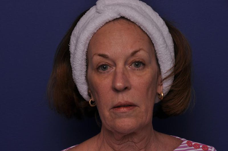 Renuva Before & After Gallery - Patient 112689 - Image 3