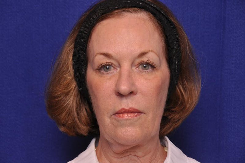 Renuva Before & After Gallery - Patient 112689 - Image 4