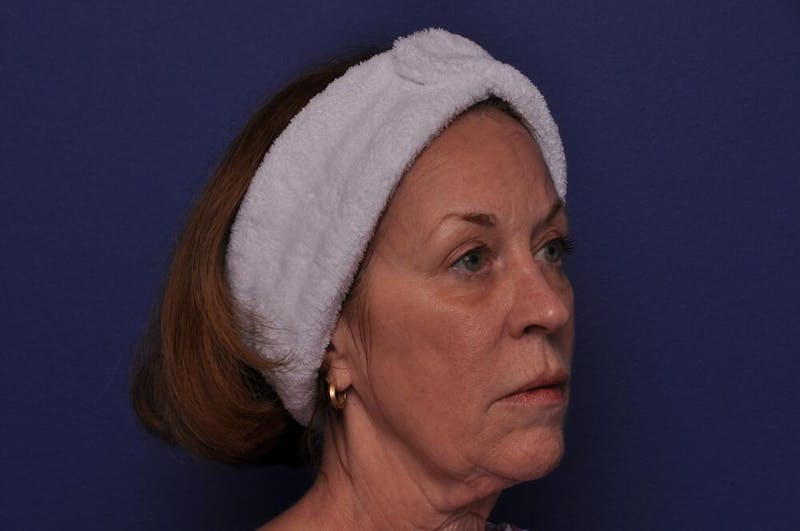 Renuva Before & After Gallery - Patient 112689 - Image 5